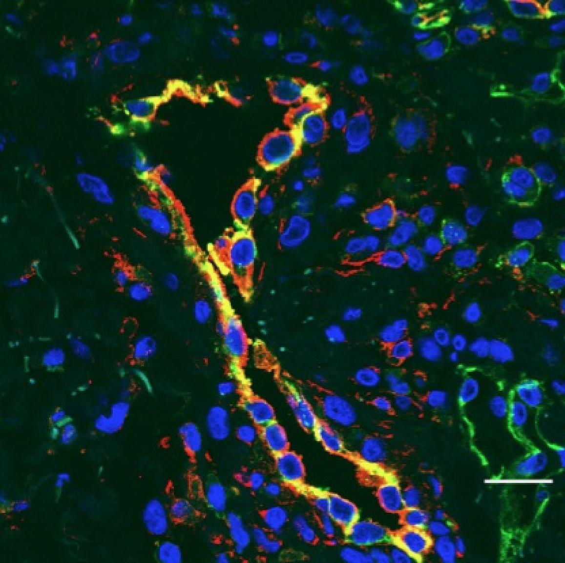 Blood vessels (outlined in yellow) of children with SAVI become inflamed