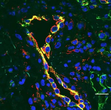 Blood vessels (yellow) of children with SAVI become inflamed and damaged indicated here in red.