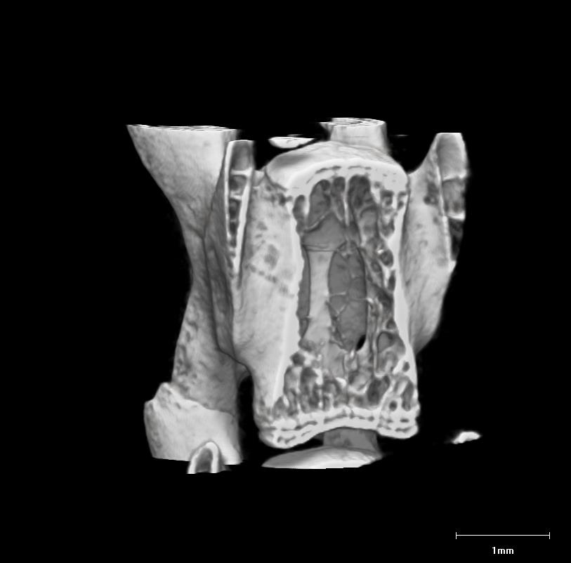 Vertebra from a mouse engineered to have osteogenesis imperfecta (upper panel). Following eight weeks of treatment with an antibody that blocks TGF-β activity the bone mass returned to normal levels (lower panel). Credit: Brendan Lee M.D. Ph.D. Baylor College of Medicine.