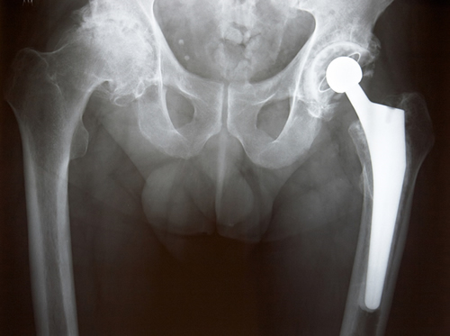 X-ray of a hip replacement.