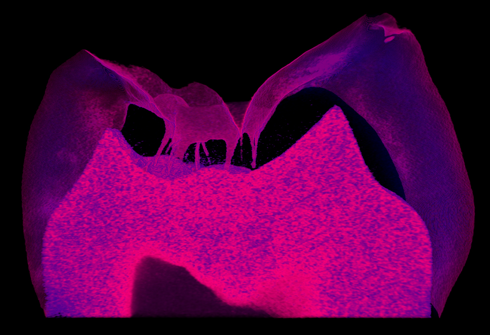 Finger-like projections (magenta) into a tooth’s top layer represent damage to the enamel of a person with a keratin 75 mutation.