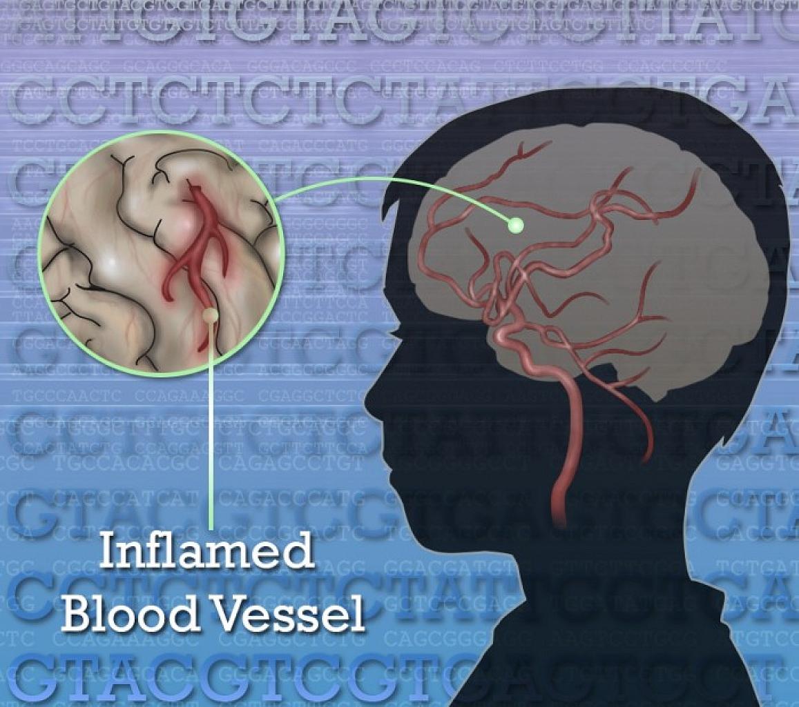 A variation in the gene that makes a key blood vessel enzyme makes children prone to fevers rash and strokes.NHGRI/NIH