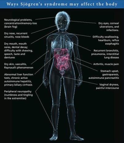 The most common symptoms of Sjögren’s syndrome are dry eyes and mouth but the disease can affect other tissues and organs as well.  Credit: Sjögren’s Syndrome Foundation.