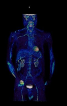 PET scan. 