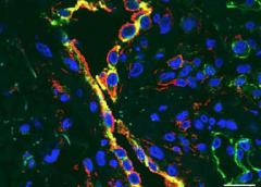 Blood vessels (yellow) of children with SAVI become inflamed and damaged indicated here in red.