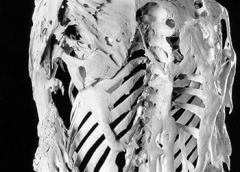 Photo of a skeleton of FOP patient.