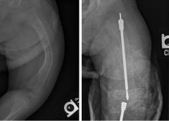 Typical bowed femur from an OI patient (left) which is often corrected by inserting a surgical rod (right).