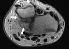 X-ray image cross-section of a wrist showing inflammation.