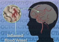 A variation in the gene that makes a key blood vessel enzyme makes children prone to fevers rash and strokes.NHGRI/NIH