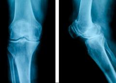 X-ray image of knee.