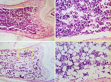 A bone from a control mouse, top, compared to one from a Cbfβ-deficient mouse, bottom. The right column shows higher magnifications of the highlighted areas on the left. The Cbfβ-deficient images show reduced bone density and more white, round adipocytes.