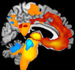 Brain tissue loss associated with Frontotemporal Lobar Degeneration