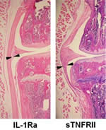 1L-1Ra vs. sTNFRII