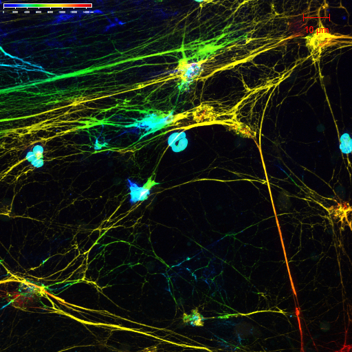 NET formation from a type of neutrophil called a low-density granulocyte.