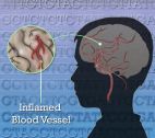 Drawing of a brain section with an inflamed blood vessel