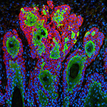 Uncontrolled growth of cells in SCC